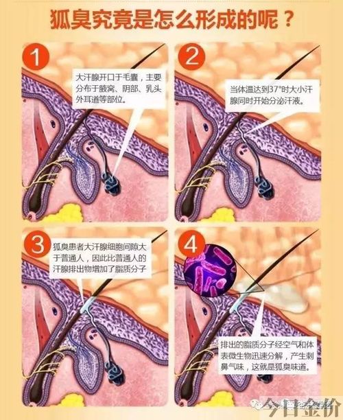 黄金微针治疗腋臭原理