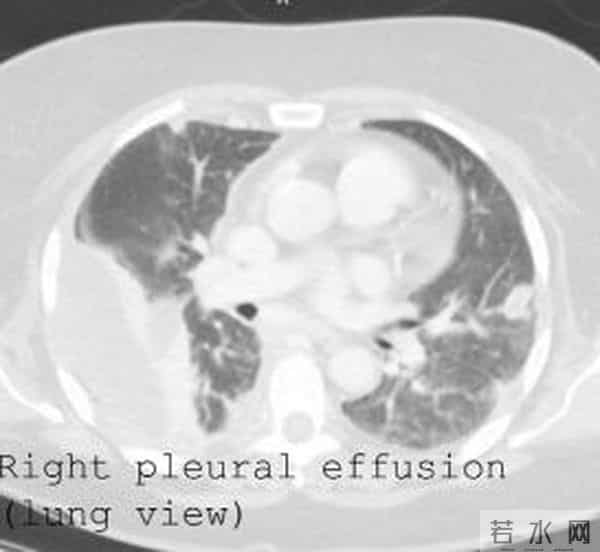全球日增确诊超46万