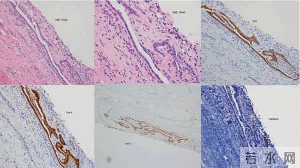 全球日增确诊超46万