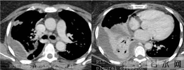 全球日增确诊超46万