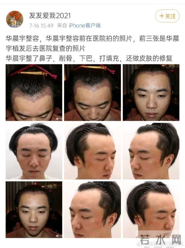 花花整容到什么程度了