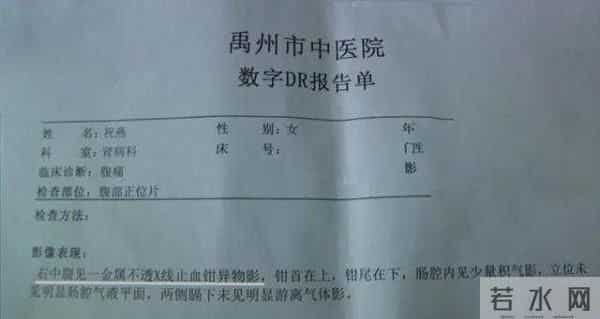 女子腹中藏有止血钳