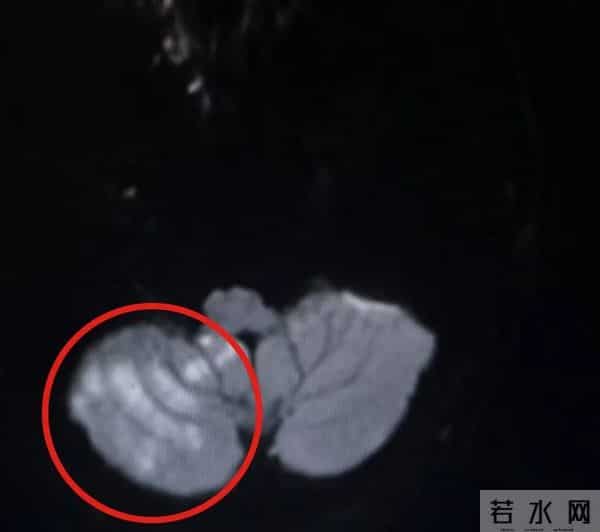 杭州按摩女:杭州女子好心按摩,却致丈夫小脑梗死!类似悲剧不止一起