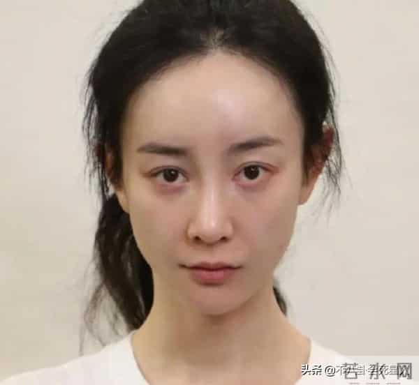 古巨基割双眼皮