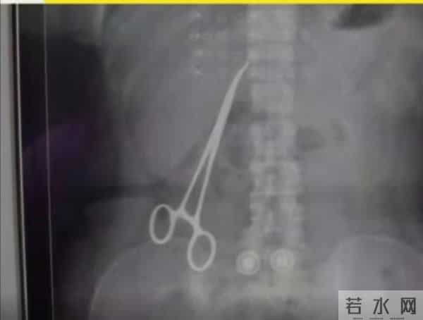 女子腹中藏有止血钳