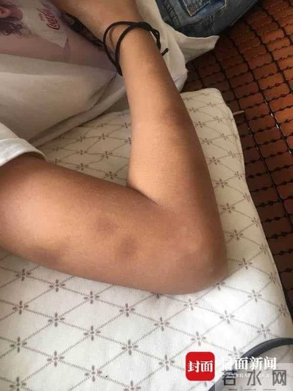 学生做错题被老师揪出瘀痕 学校:老师已调离岗位