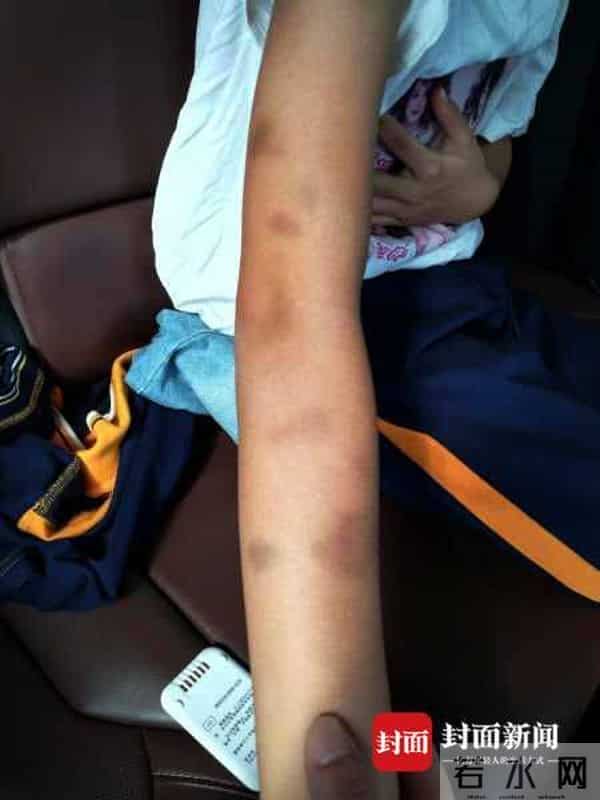 学生做错题被老师揪出瘀痕 学校:老师已调离岗位