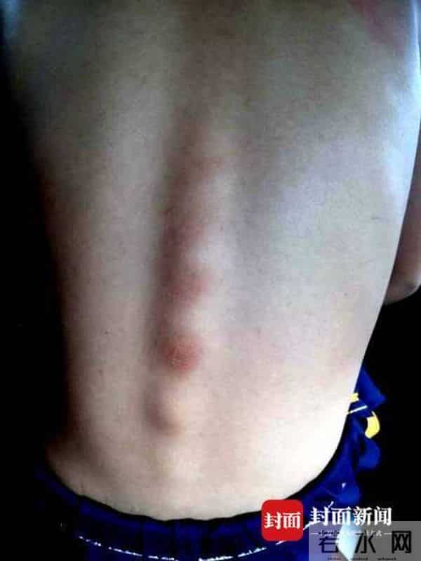 学生做错题被老师揪出瘀痕 学校:老师已调离岗位