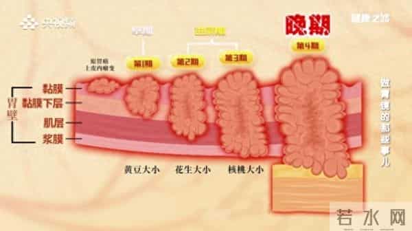 两年4次胃镜漏诊胃癌！饭后出现这4个症状要当心
