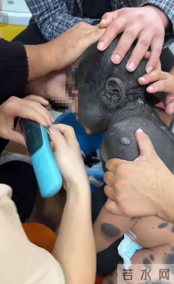 儿子车祸去世！二胎孩子却患兽皮痣，长满黑皮毛，宝妈崩溃痛哭