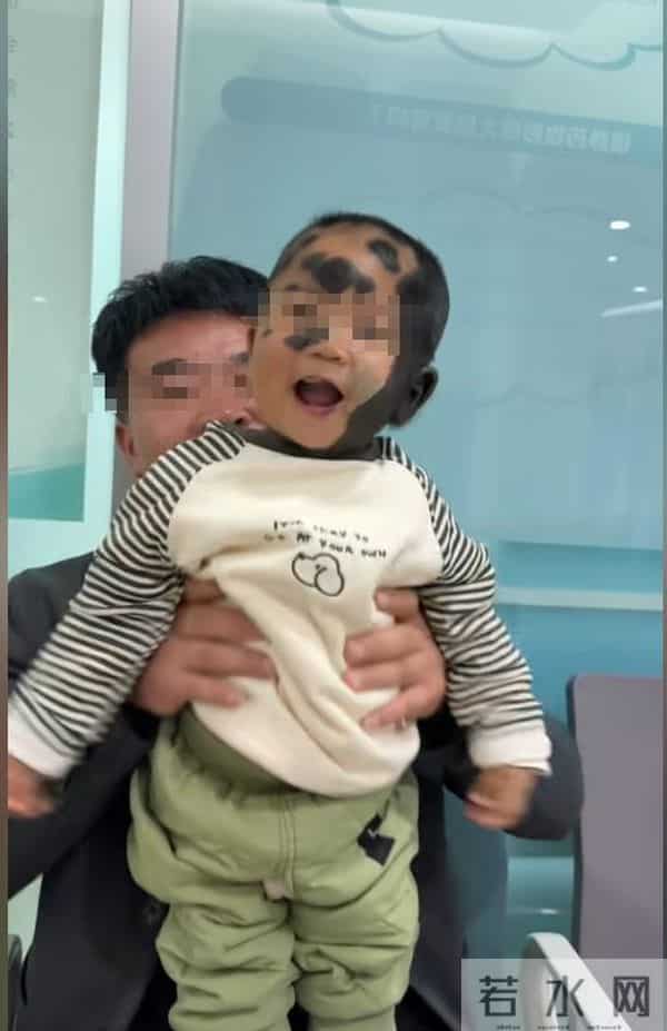 儿子车祸去世！二胎孩子却患兽皮痣，长满黑皮毛，宝妈崩溃痛哭