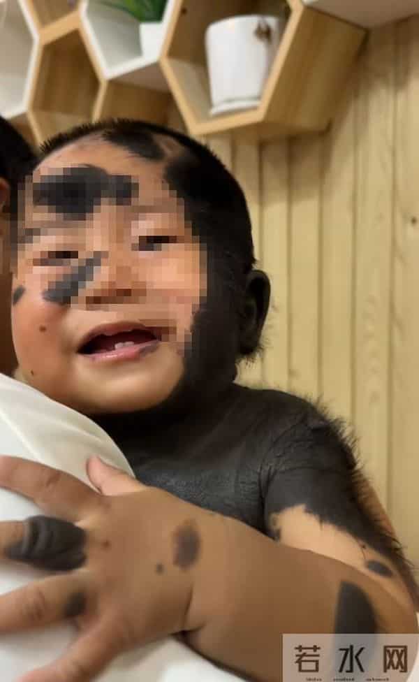 儿子车祸去世！二胎孩子却患兽皮痣，长满黑皮毛，宝妈崩溃痛哭