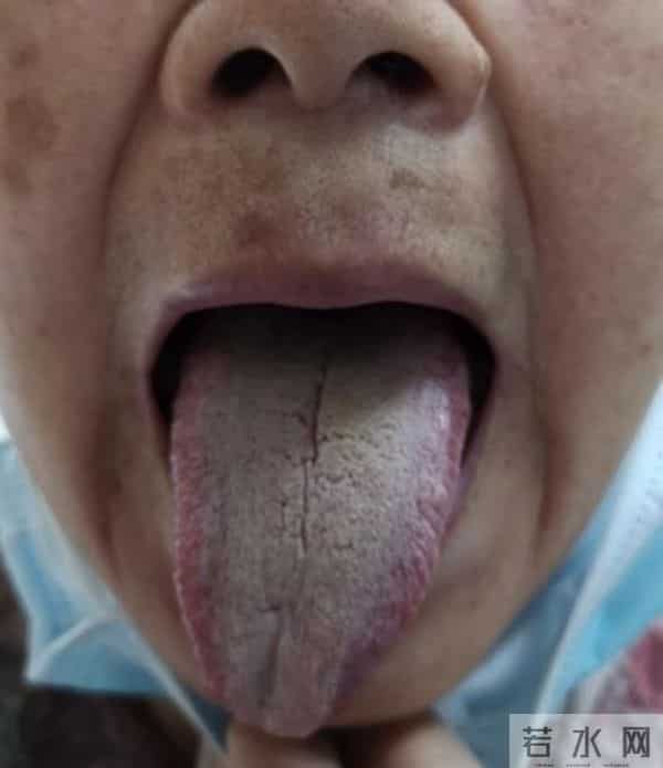 80岁阮女士便秘6年，仅用药3周已得到全面改善