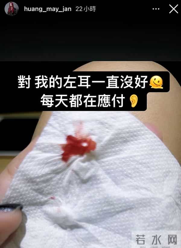 39岁女歌手听力只剩两成,左耳时常出血,此前还患恐慌症长达14年