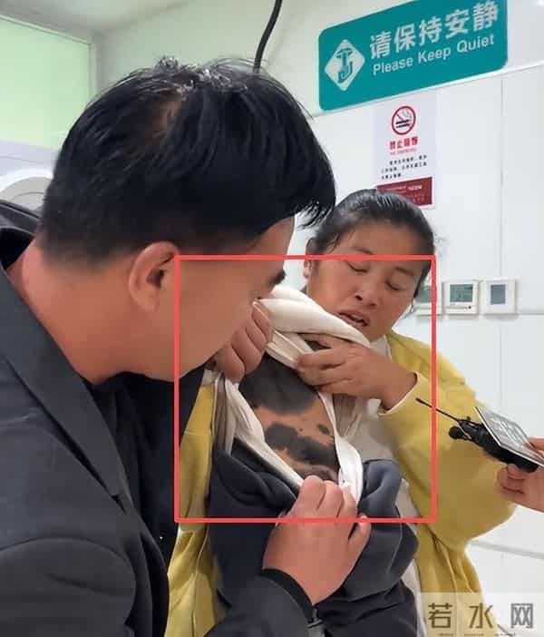 儿子车祸去世！二胎孩子却患兽皮痣，长满黑皮毛，宝妈崩溃痛哭