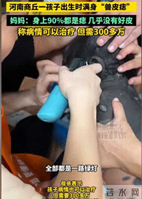 儿子车祸去世！二胎孩子却患兽皮痣，长满黑皮毛，宝妈崩溃痛哭