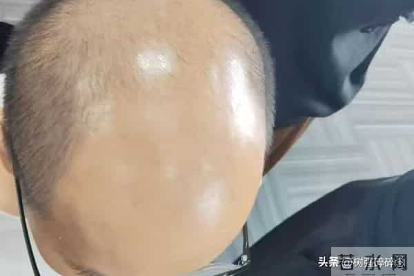 惊！90后脱发占比52%！别只怪熬夜，用错洗发水都在悄悄伤头皮