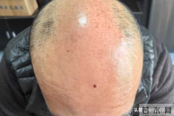 惊！90后脱发占比52%！别只怪熬夜，用错洗发水都在悄悄伤头皮