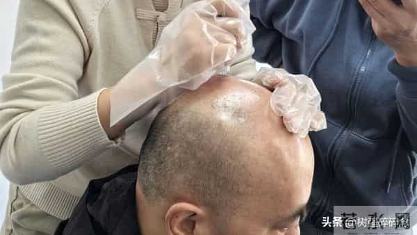 惊！90后脱发占比52%！别只怪熬夜，用错洗发水都在悄悄伤头皮