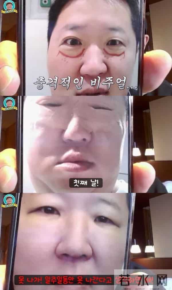 韩男星坦承整形!术后肿到不行「像被暴打」 眼睛惨剩一条缝