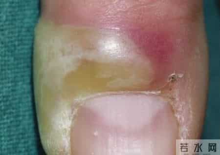 梦到鞋坏了,指甲为什么总从这里断开？是缺钙吗？这些身体信号要注意