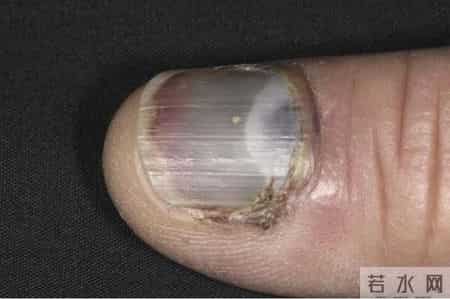 梦到鞋坏了,指甲为什么总从这里断开？是缺钙吗？这些身体信号要注意