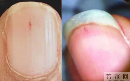 梦到鞋坏了,指甲为什么总从这里断开？是缺钙吗？这些身体信号要注意