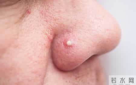 蒲公英教案,五味消毒饮，专为治疗大而深的痘痘而创的方子