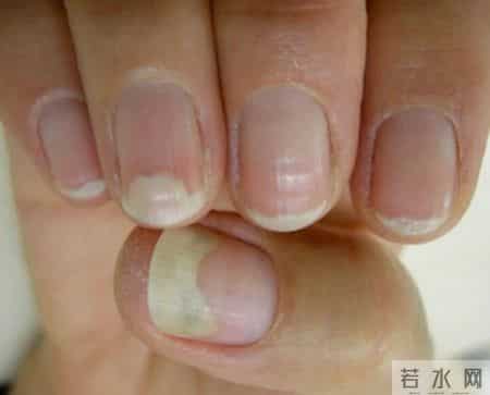 梦到鞋坏了,指甲为什么总从这里断开？是缺钙吗？这些身体信号要注意