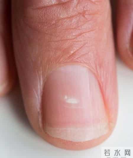 梦到鞋坏了,指甲为什么总从这里断开？是缺钙吗？这些身体信号要注意