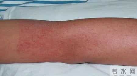 广东新增本土确诊47例,广东佛山顺德区确诊478例 小心这种由“花蚊子”传染的病