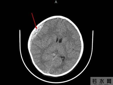 紧急提醒!浙江多人离奇发烧!已有人死亡,心碎！浙江2岁妹妹，3岁哥哥遇难……紧急提醒：不要去，不要去