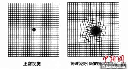 三分之一眼底医生,3 眼底检查主要用来查哪些病